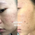 Hình ảnh Thực Tế Review Combo Giảm Mụn Viêm Mủ Biotrade Acnaut - 7Mart.vn
