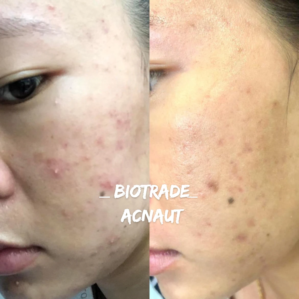 Hình ảnh Thực Tế Review Combo Giảm Mụn Viêm Mủ Biotrade Acnaut - 7mart.vn