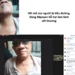 Vết Sẹo Mổ Của Người Bị Tiểu đường Dùng Mpower Hỗ Trợ - 7Mart.vn